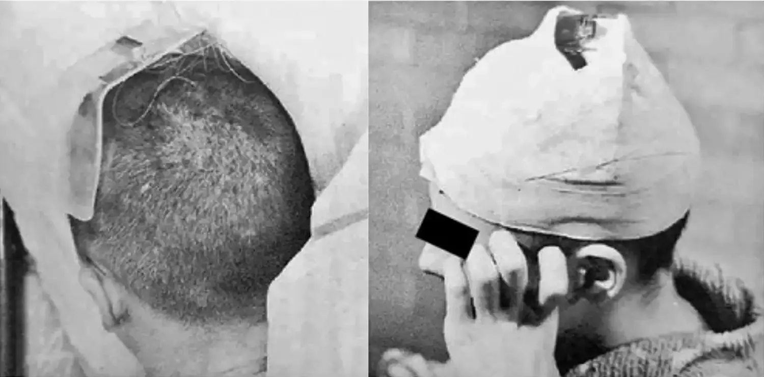 Two photos showing a headpiece mounted to a man with a shaved head. The first photo shows the headpiece and the back of the head, while the second one shows the headpiece and head wrapped in tape. Two photos showing a headpiece mounted to a man with a shaved head. The first photo shows the headpiece and the back of the head, while the second one shows the headpiece and head wrapped in tape.